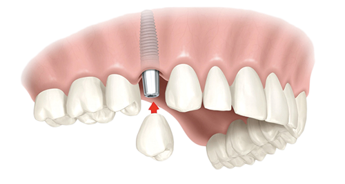 Single Dental Implants Homewood
