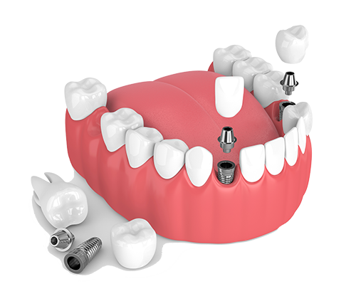 Multiple Teeth Dental Implants in Homewood